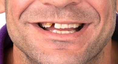 Close up image of a patient with missing and broken teeth before dental treatment.
